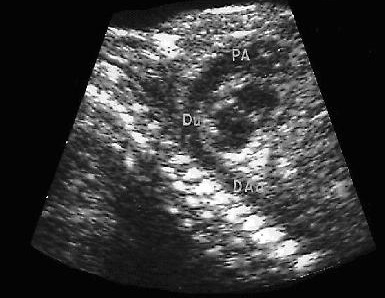 ecocardiograma fetal 3
